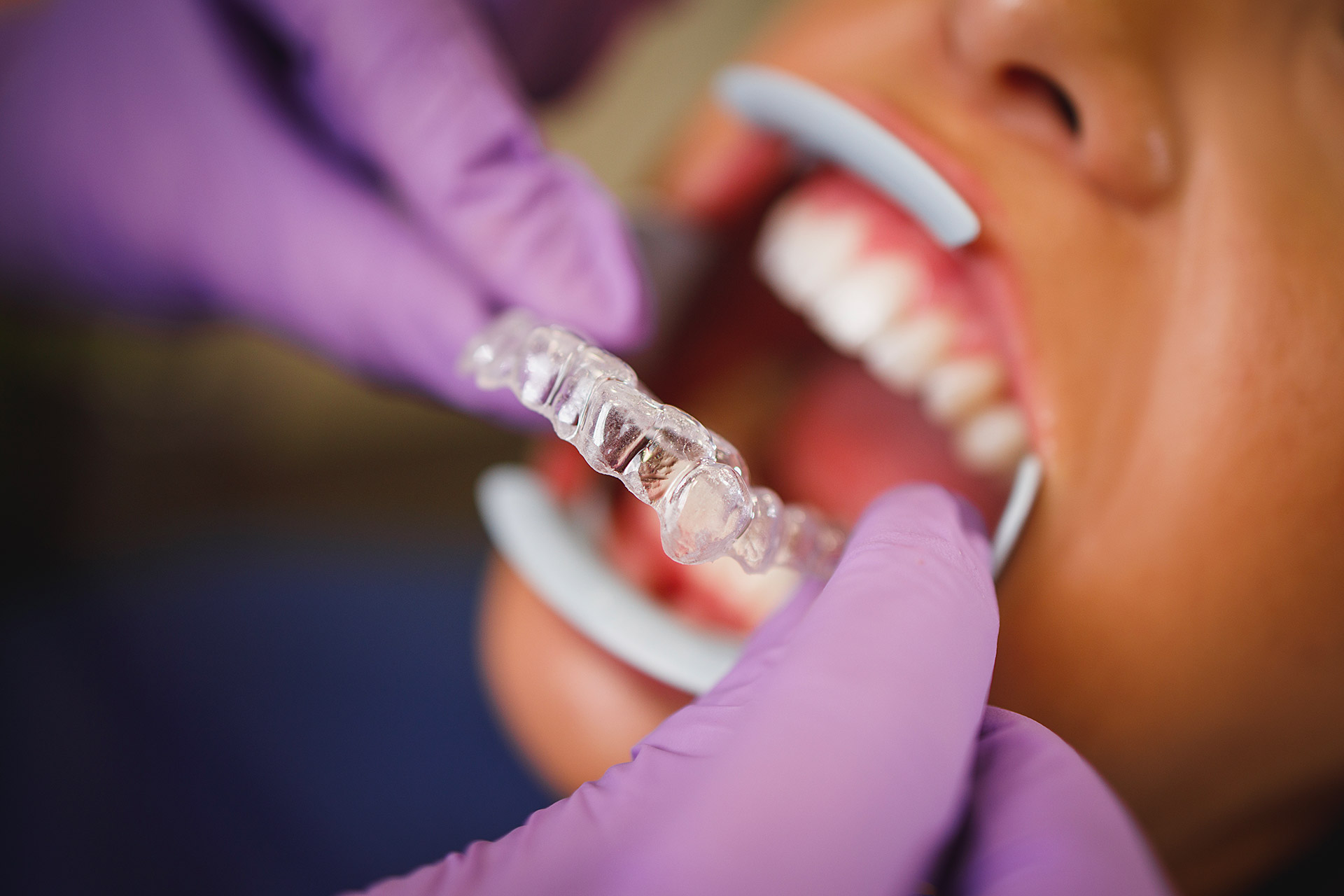Comparatif gouttieres dentaire orthodontiste Invisalign et lowcost dental geneva