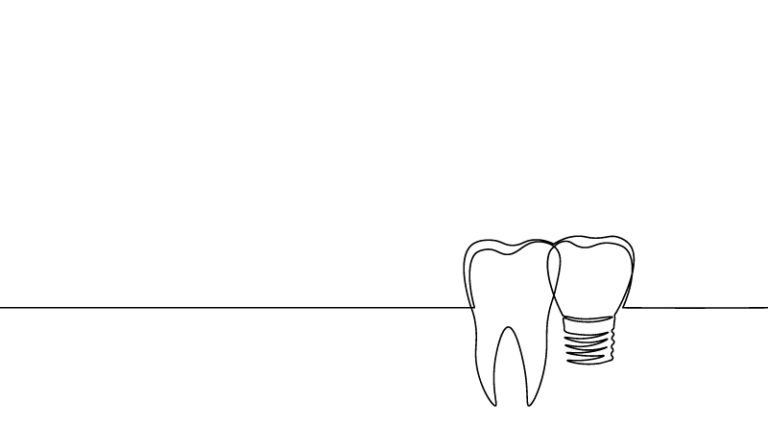 Avantage des implants courts en chirurgie dentaire, au cabinet Dental Geneva