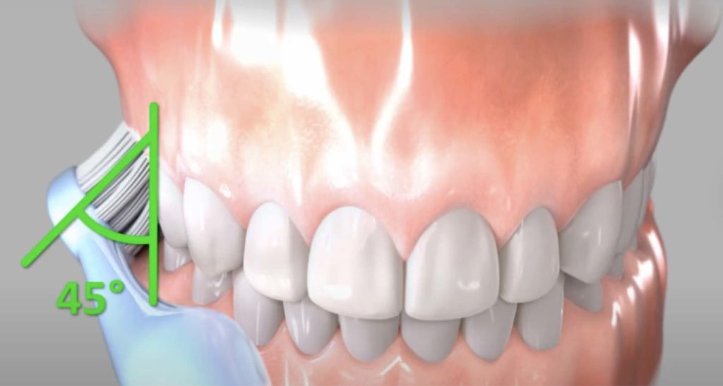 Illustration of the correct brushing technique: toothbrush tilted at 45° towards the gingival sulcus, small back-and-forth movements before sweeping outwards.