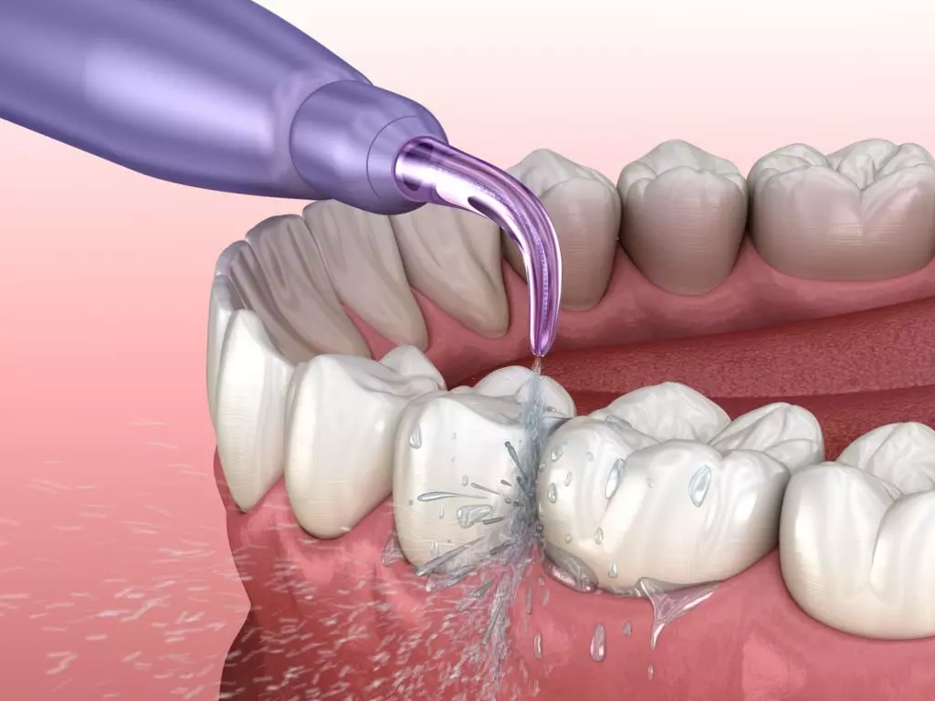 Detartrage blanchiment Dental Geneva