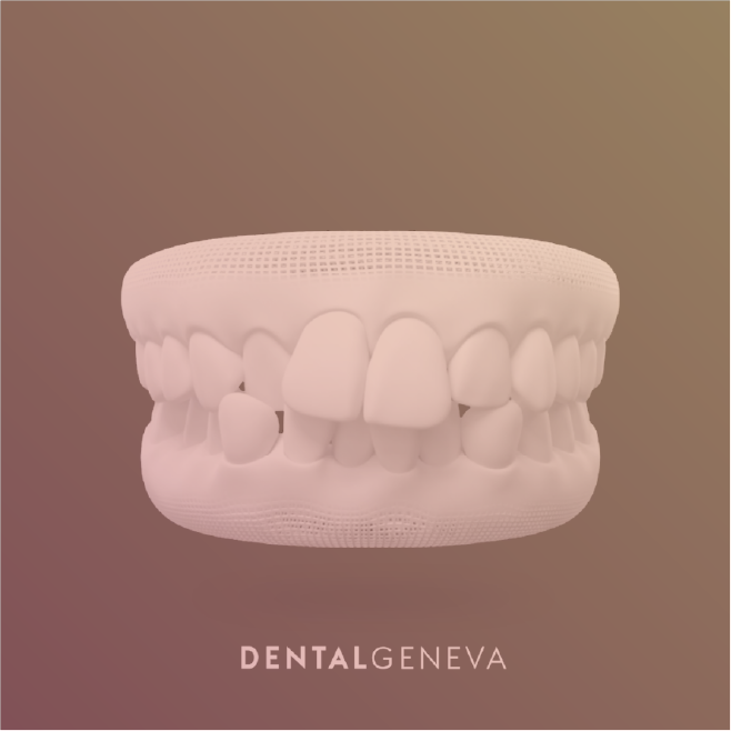 Invisalign® aligners - Centre dentaire Lancy - Genebra