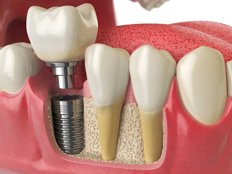 Implant dentaire dentiste cornavin