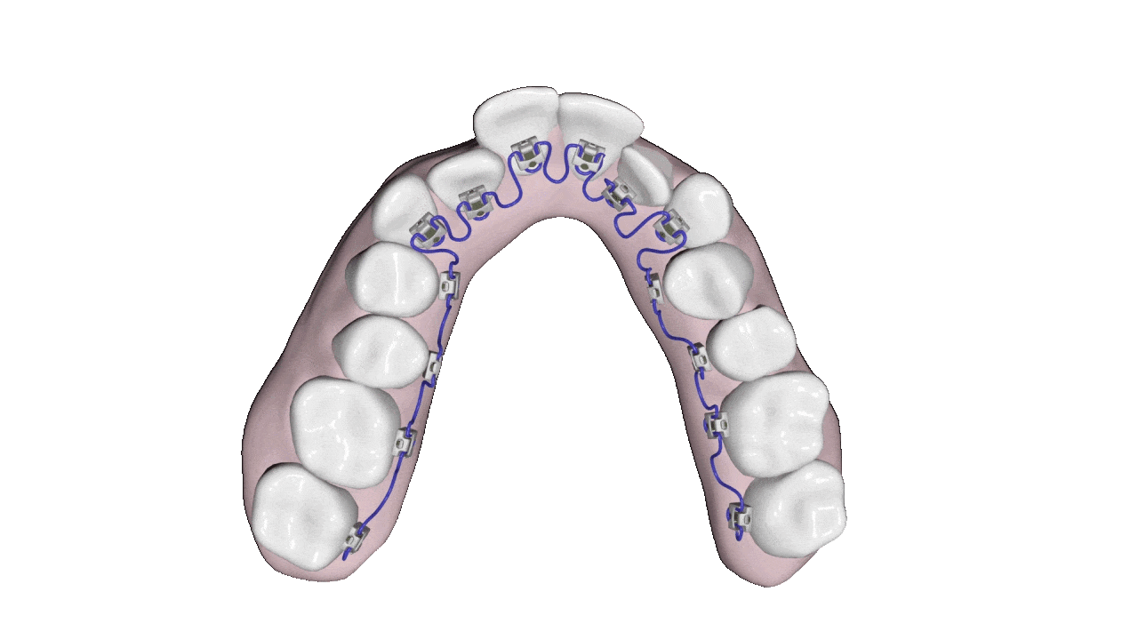 Orthodontie linguale Incognito Geneve