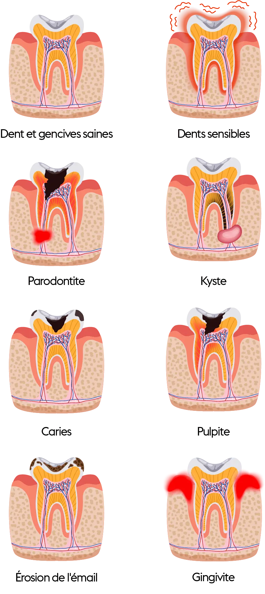 Traitement carie dentaire dentiste geneve