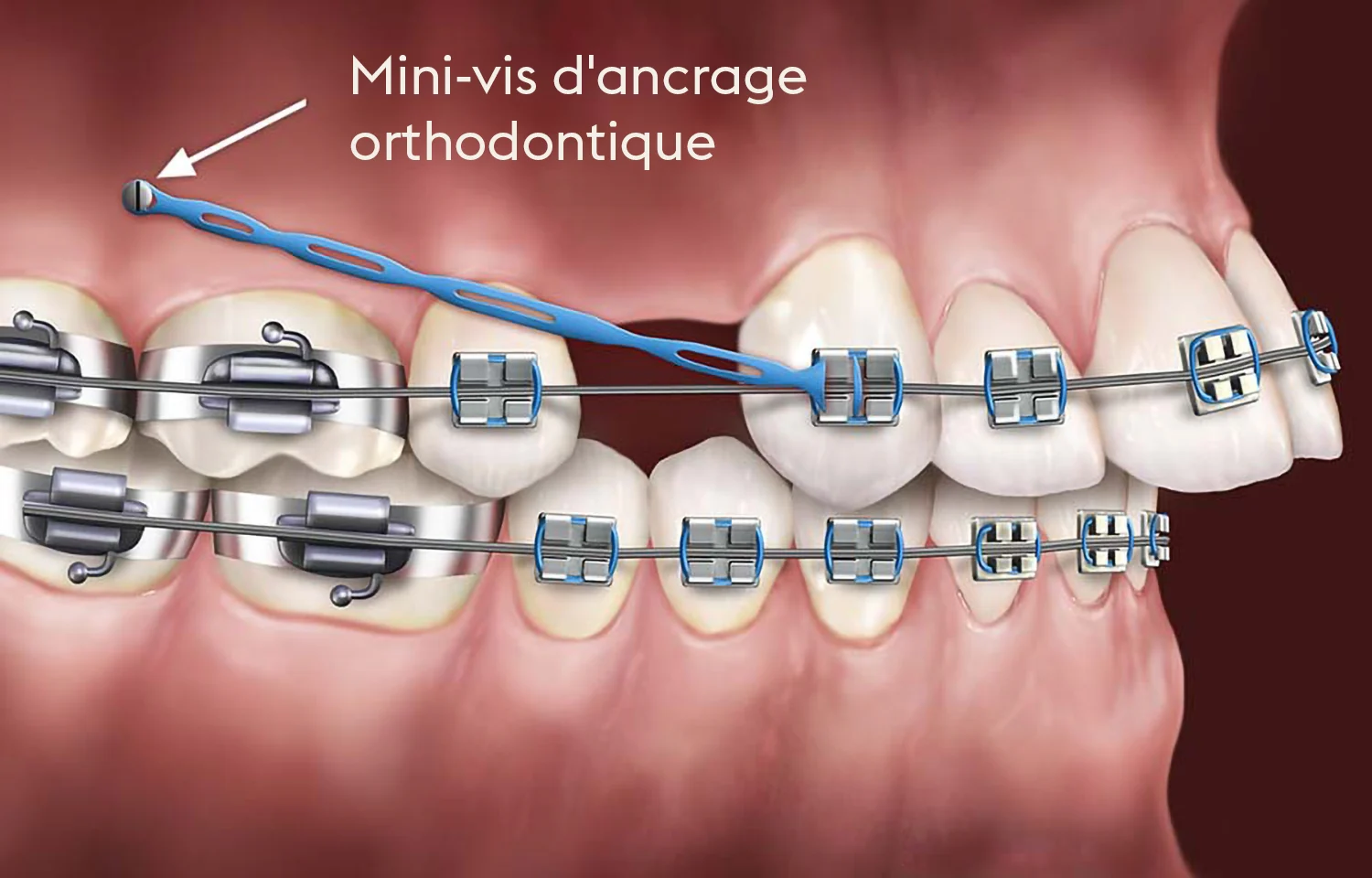Implant ancrage orthodontique Geneve