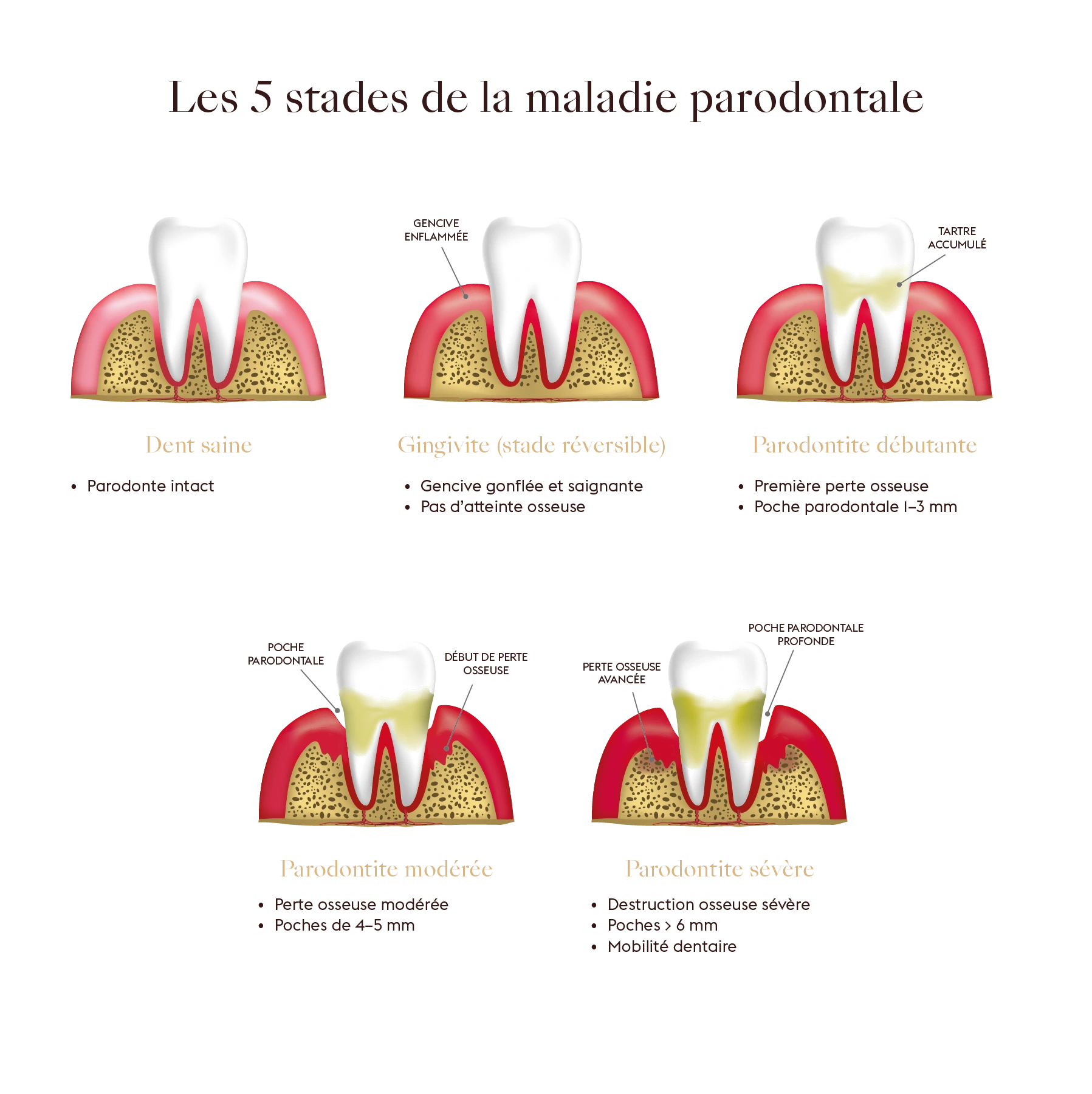 Illustration des 5 stades de la maladie parodontale, de la gingivite à la parodontite sévère – Dental Geneva