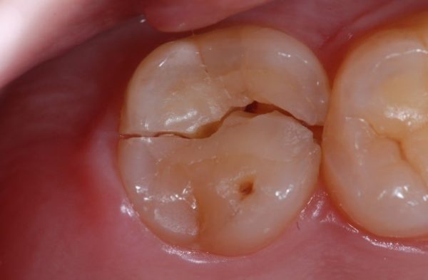 Close-up photo of a cracked tooth showing a longitudinal fracture line.