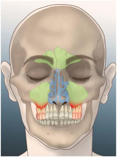 Illustration showing the roots of the upper molars in contact with the floor of the maxillary sinus.