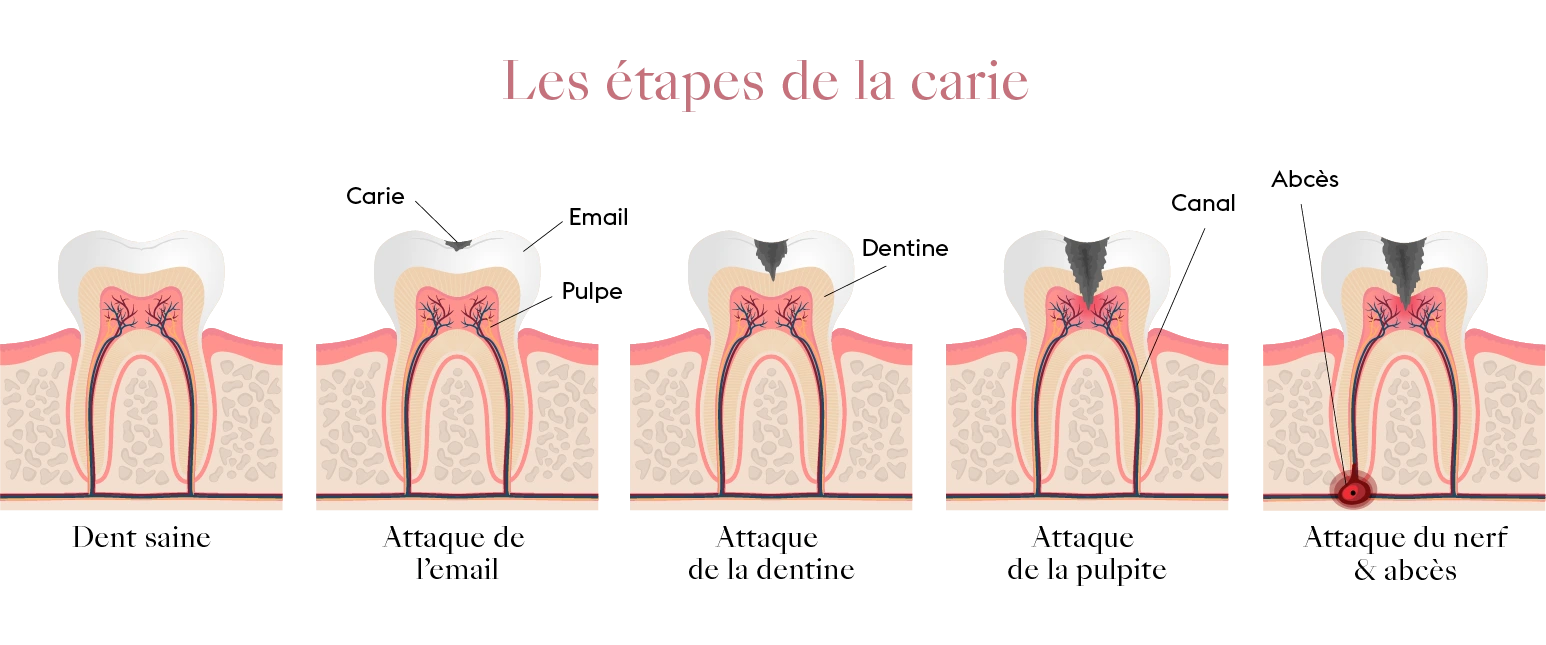 Schéma montrant les 5 étapes de l’évolution d’une carie dentaire, de l’émail à la pulpe.
