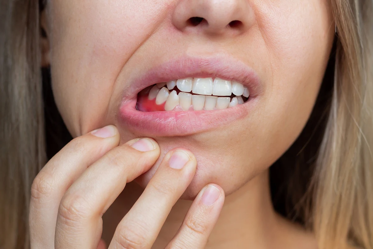Gencives qui saignent avec inflammation et rougeurs – causes, prévention et traitements proposés par Dental Geneva