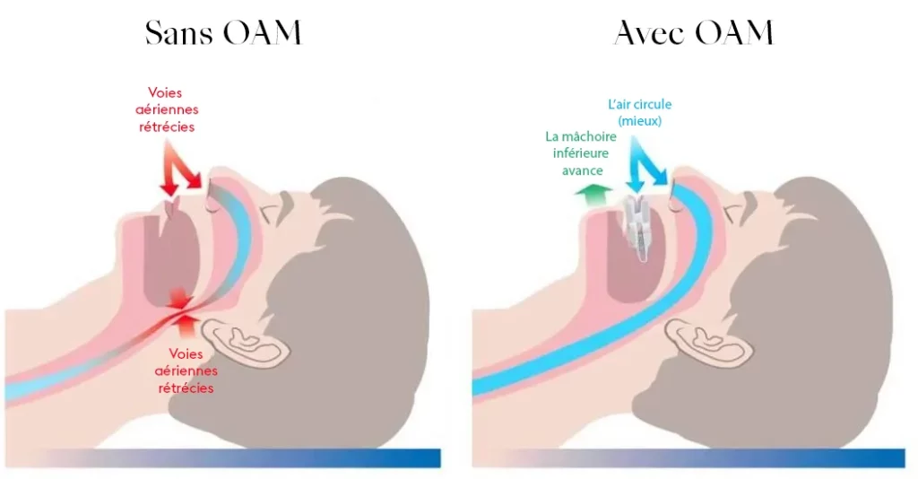 Comparative diagram: on the left without a mandibular advancement device (MAD), narrowed airways; on the right with MAD, the jaw advances and air circulates better, reducing snoring and sleep apnea.