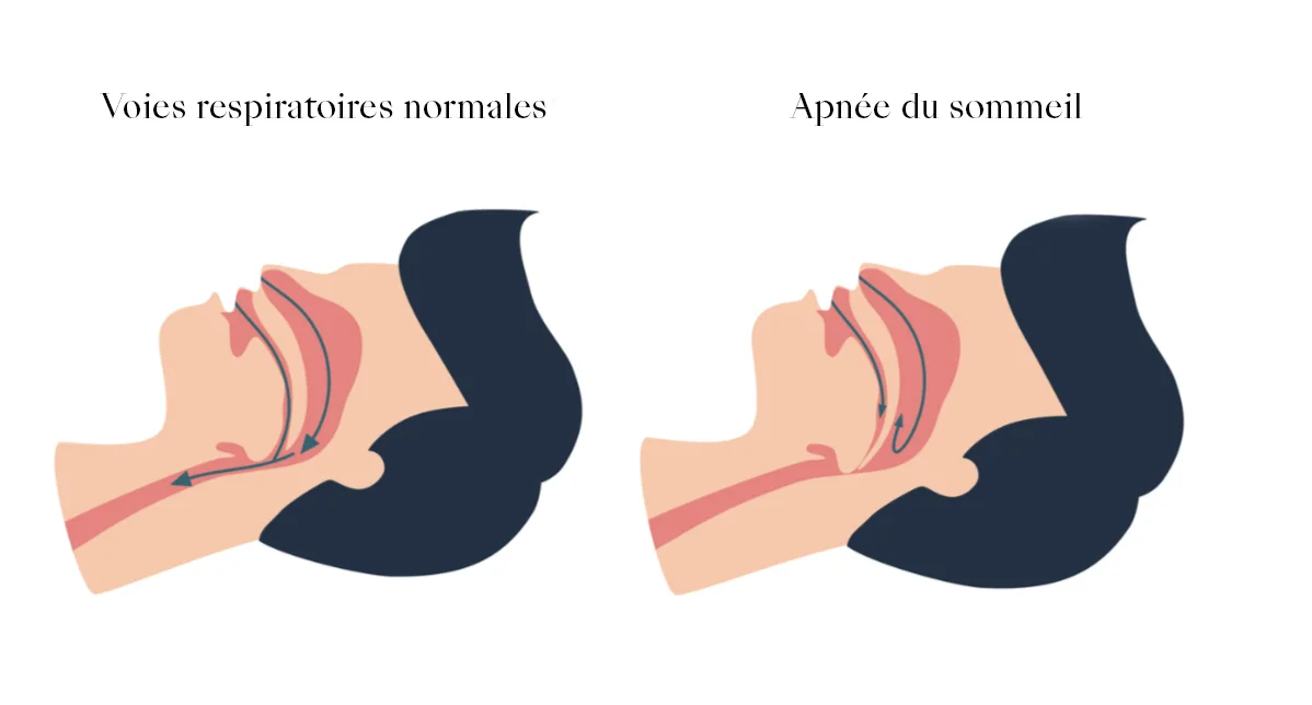 Comparative cross-section diagram: on the left, open airways (tongue advanced, soft palate clear); on the right, obstructive apnea with collapse of the soft palate and base of the tongue, narrowing the pharynx and obstructing airflow.