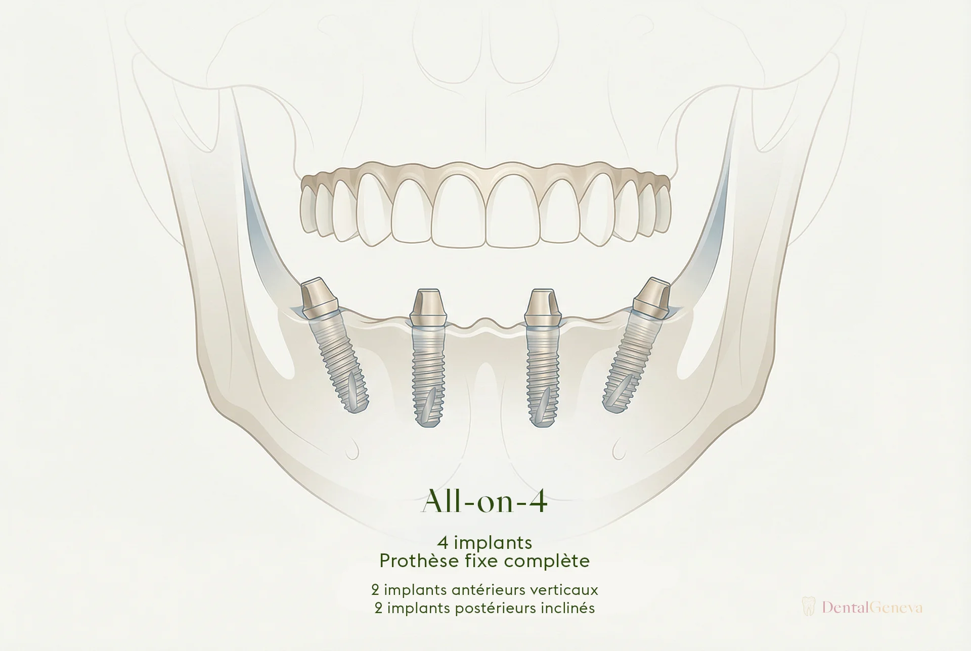 All-on-4 technique: four strategically positioned dental implants in the jaw supporting a fixed full prosthesis