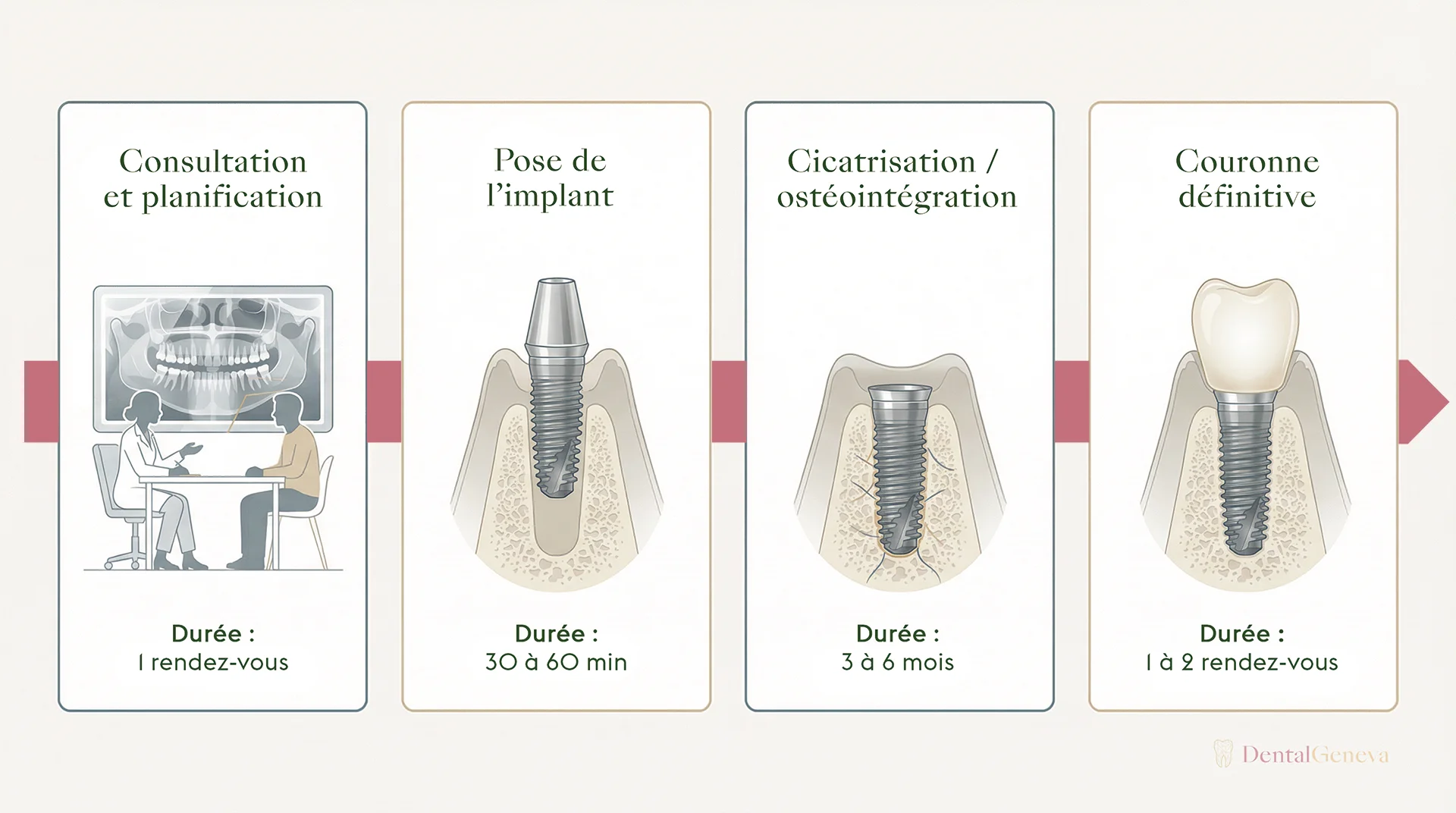 The 4 steps of dental implant placement: consultation and planning, surgical placement, osseointegration for 3 to 6 months, then definitive crown