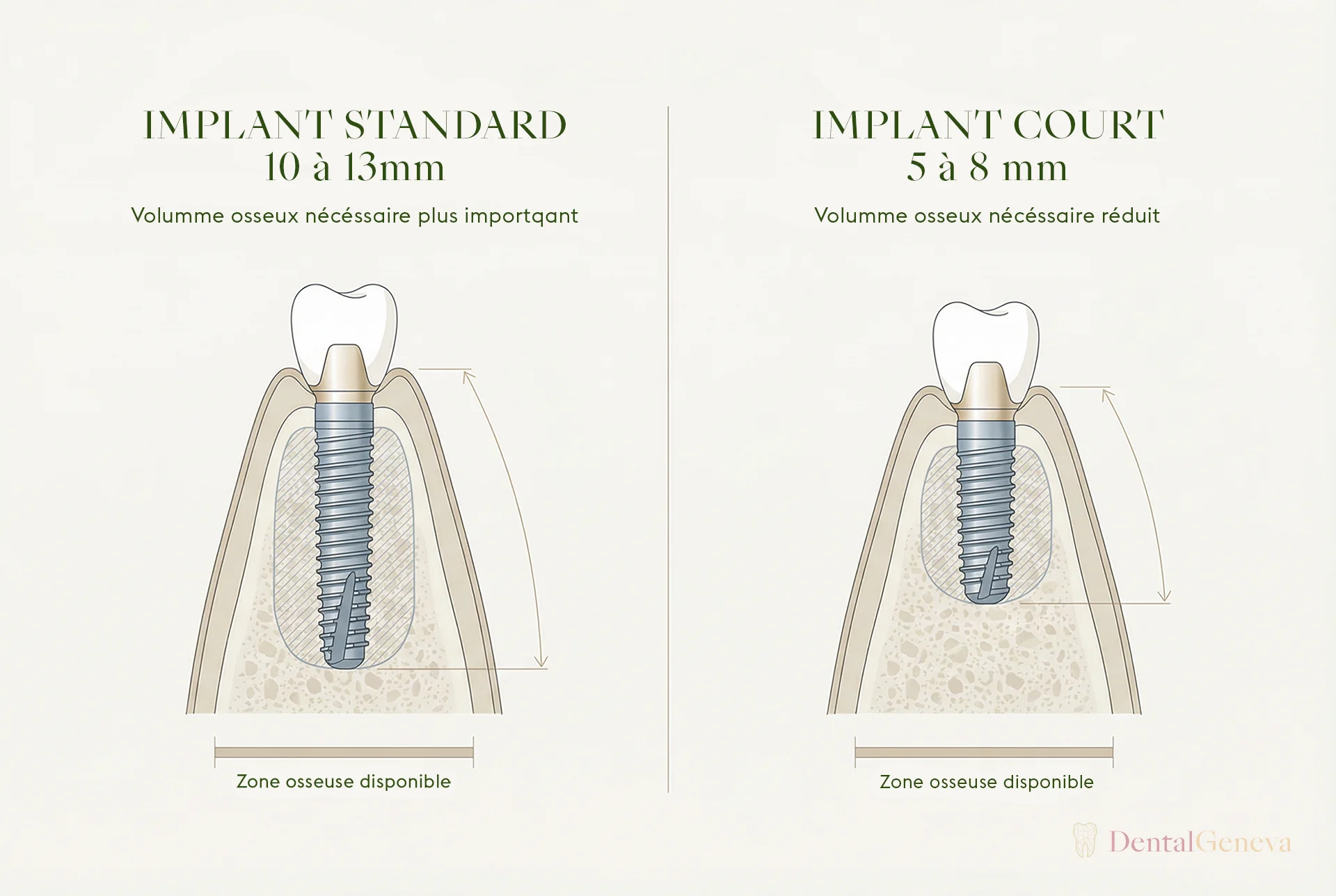 Comparison between a standard dental implant of 10 to 13 mm and a short implant of 5 to 8 mm, showing the reduced bone volume required