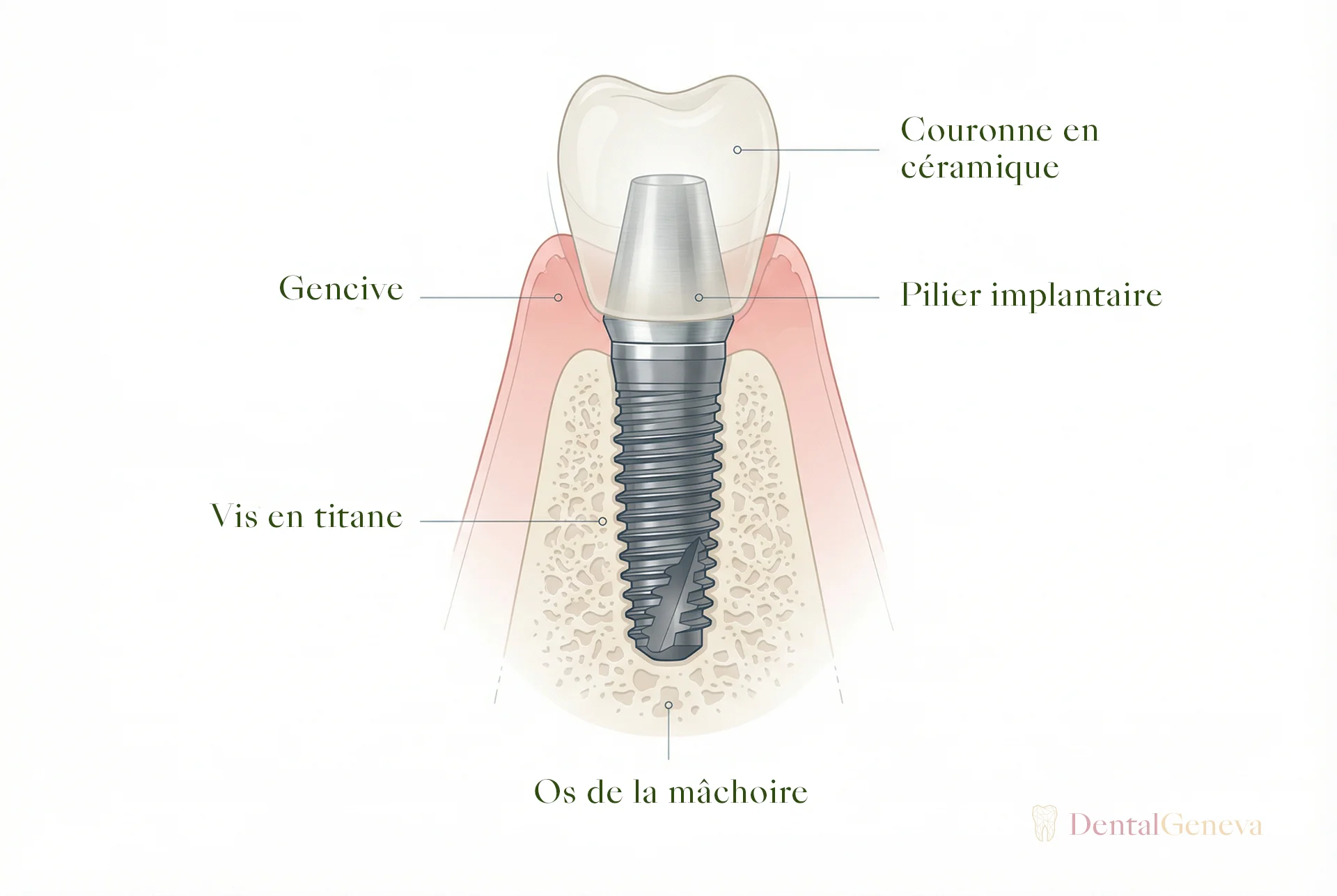 Diagram of a complete dental implant: titanium screw inserted into the jawbone, prosthetic abutment, and ceramic crown