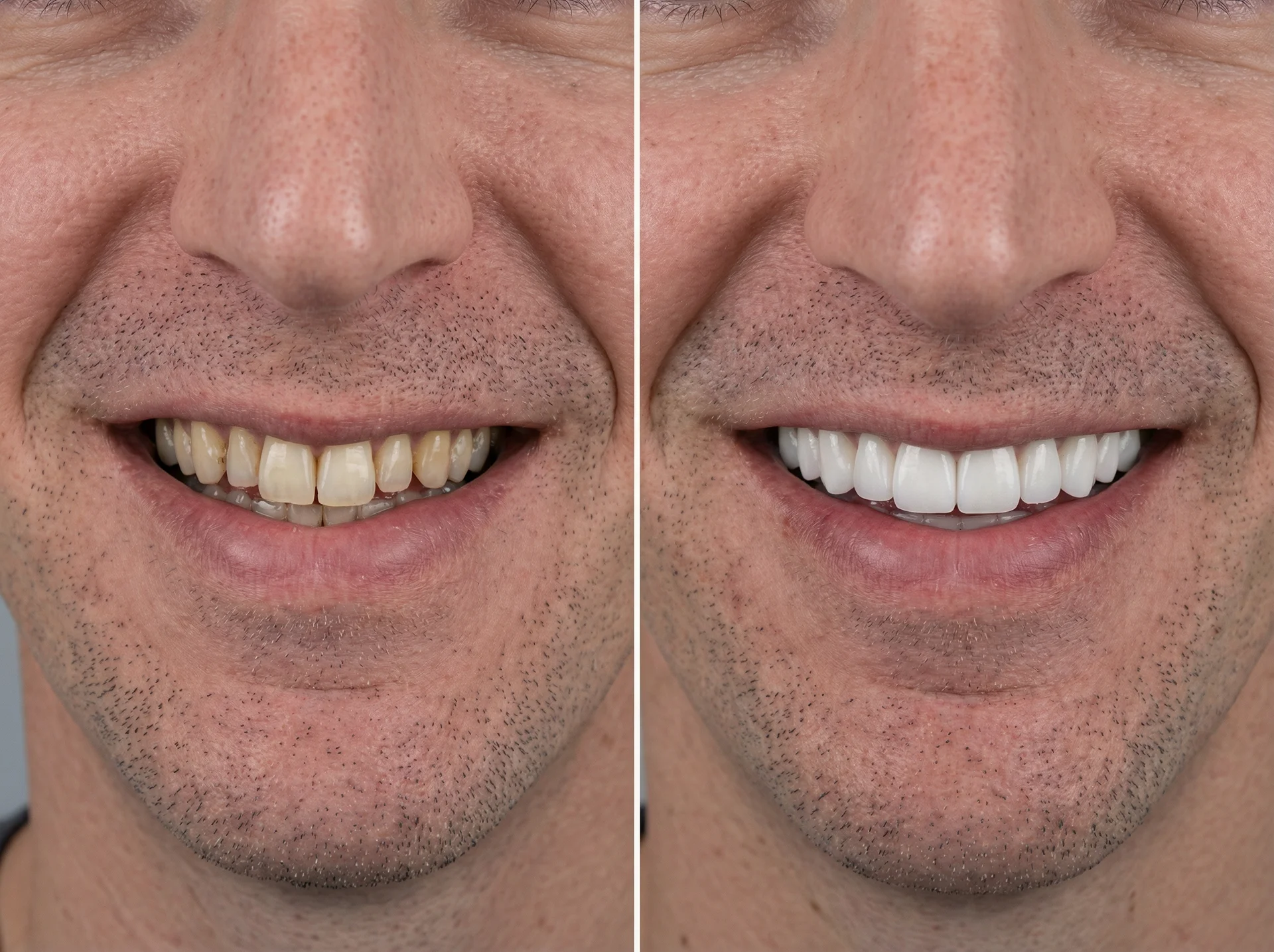 Résultat avant et après la pose de facettes dentaires en céramique : sourire transformé