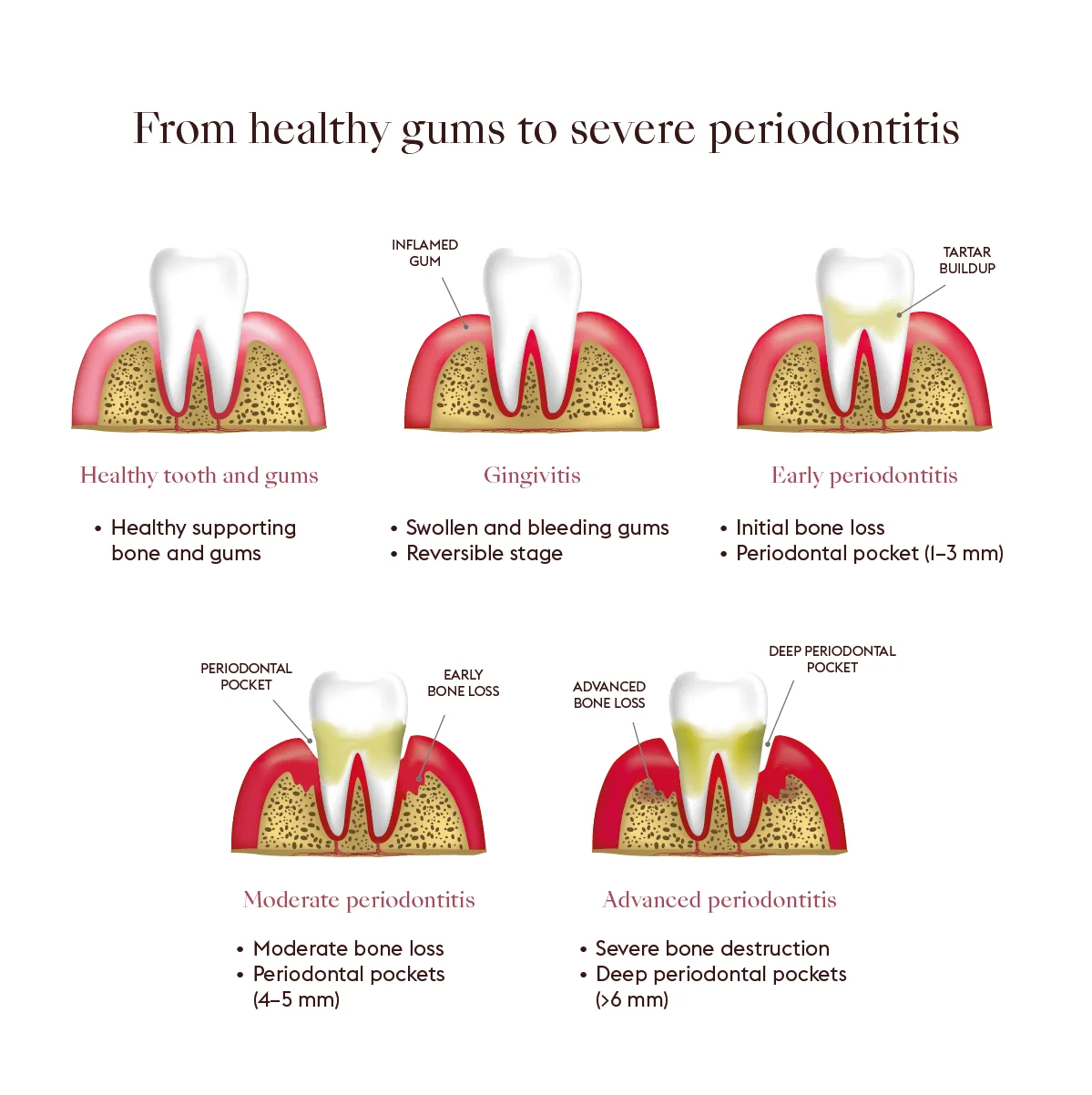 Progression of periodontal disease, from healthy gums to severe periodontitis with a deep pocket and bone loss.