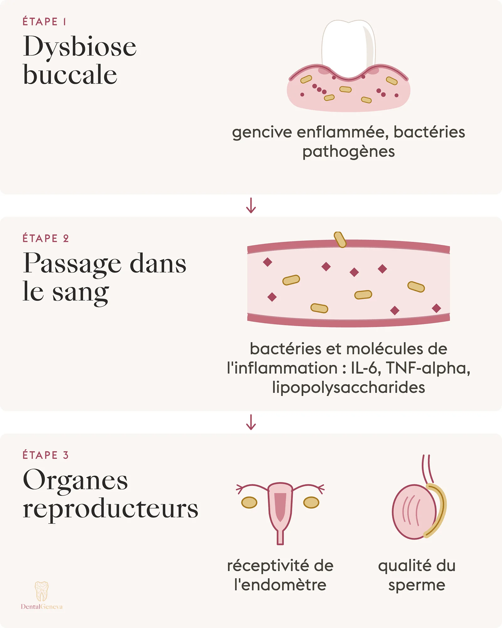 Schéma du lien entre santé bucco-dentaire et fertilité : l'inflammation des gencives gagne le sang puis les organes reproducteurs.
